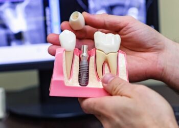 Стоимость имплантации зубов: факторы, влияющие на цену и возможности финансирования