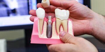 Стоимость имплантации зубов: факторы, влияющие на цену и возможности финансирования