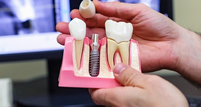 Стоимость имплантации зубов: факторы, влияющие на цену и возможности финансирования