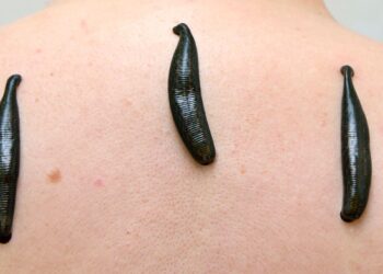 Как правильно лечиться пиявками: рекомендации специалистов