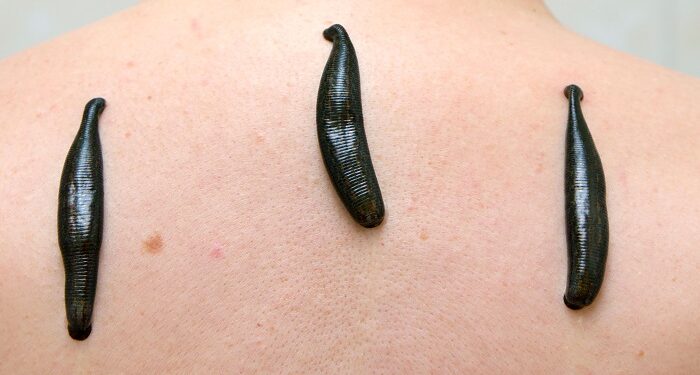 Как правильно лечиться пиявками: рекомендации специалистов